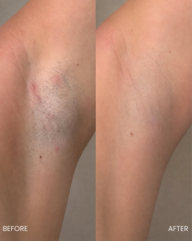 Ingrown Hair Pads with BHA + AHA