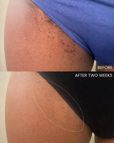 Ingrown Hair Pads with BHA + AHA