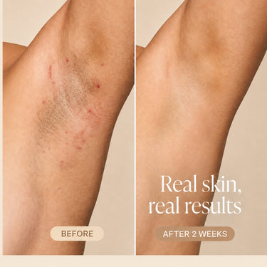 Ingrown Hair Pads Travelsize